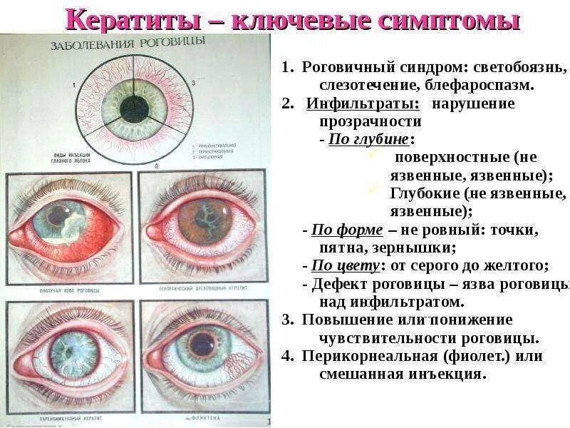 Признаки зрения 3. Глазное заболевание кератит. Воспаление роговой оболочки глаза кератит.