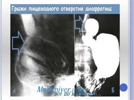 Грыжа пищеводного отверстия диафрагмы операции отзывы
