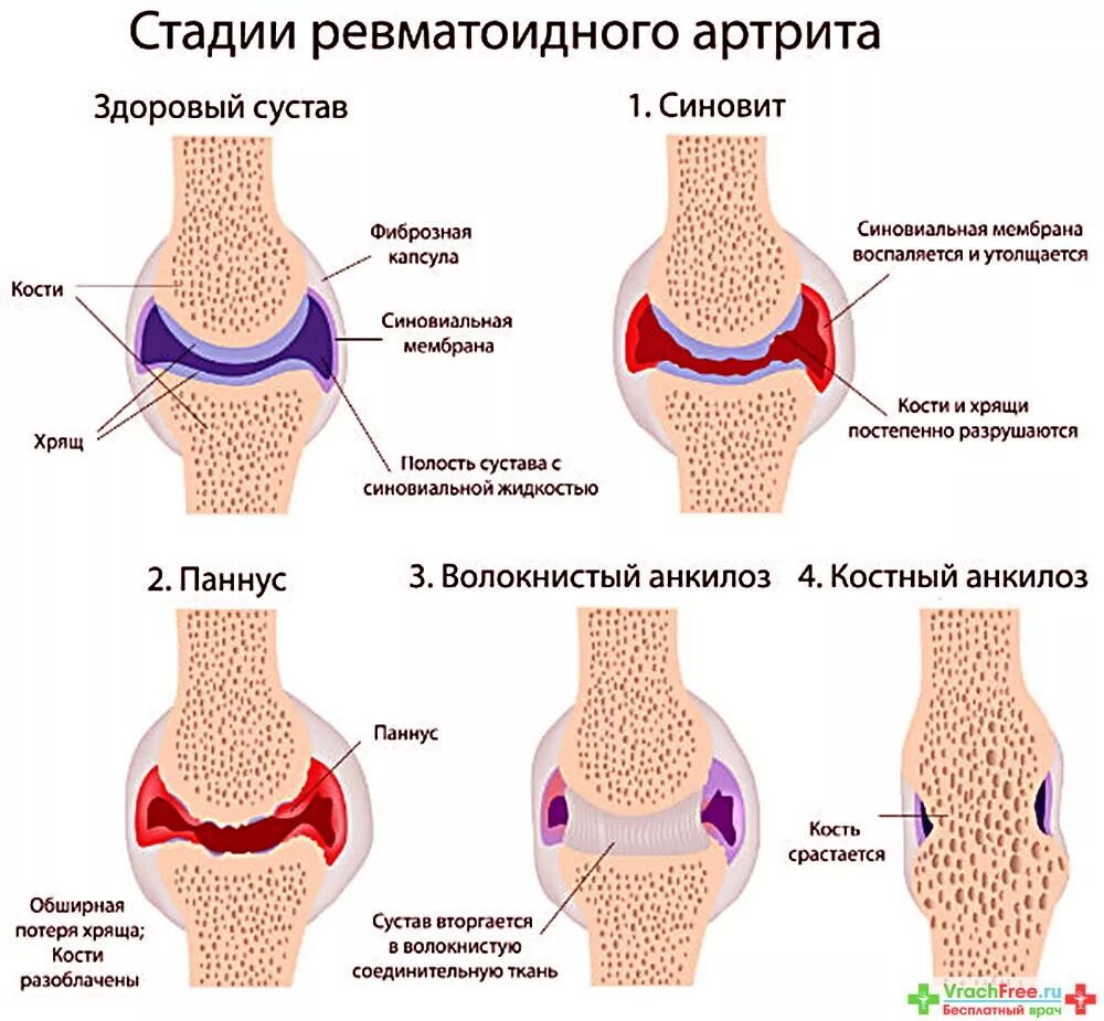Ревматоидный артрит это. Микропрепарат ревматоидный паннус. Паннус ревматоидный артрит. Поражение суставов, характерных для ревматоидного артрита. Ревматоидный артрит клинические симптомы.
