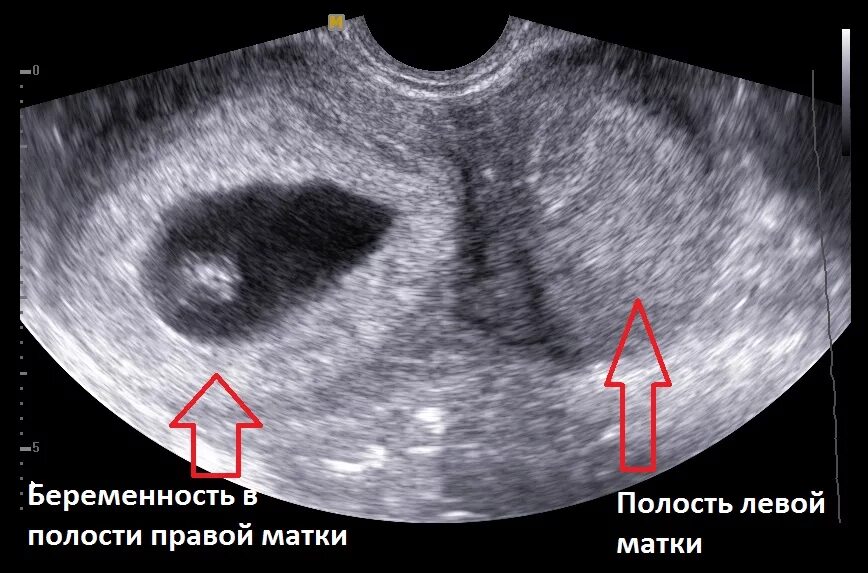 Маточная беременность на ранних сроках. Беременность в рудиментарном Роге УЗИ. Двурогая матка и беременность УЗИ. Перегородка в полости матки на УЗИ.