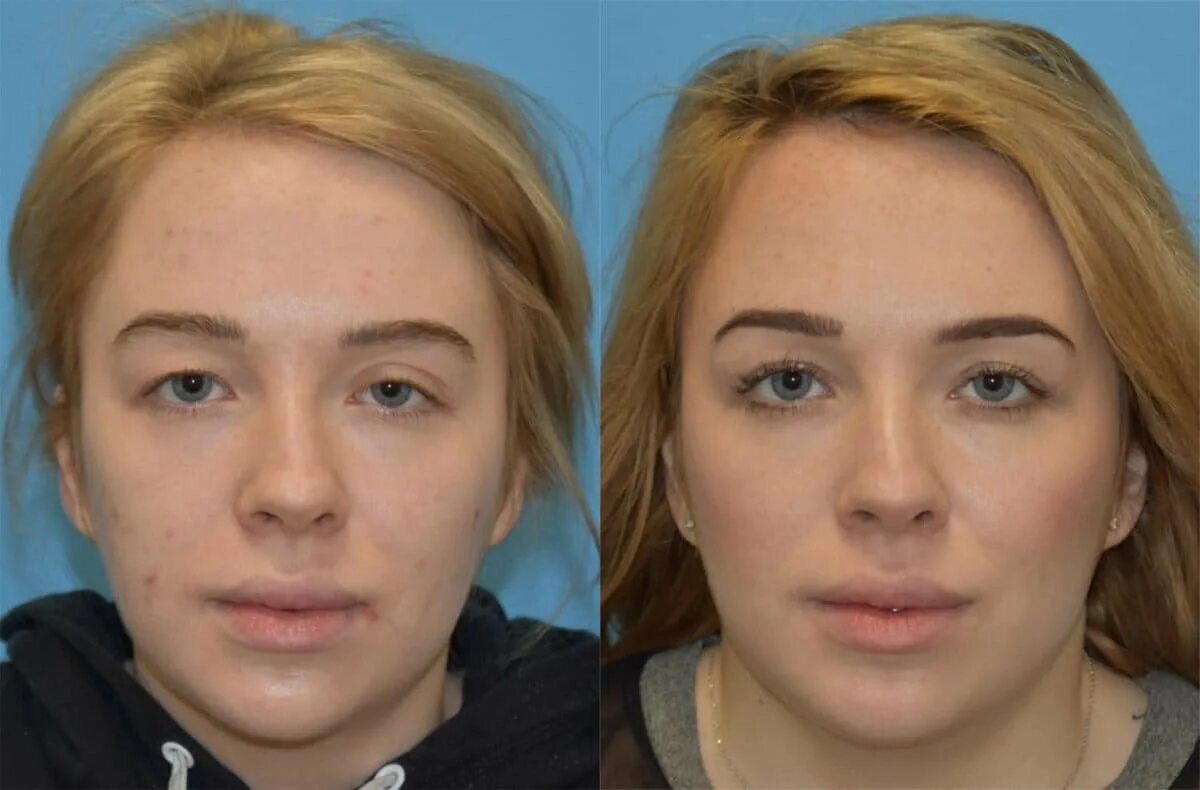 Броулифтинг. Brow Lift операция. Хирургическая подтяжка бровей.