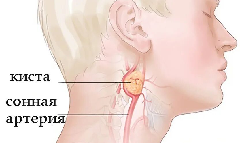 Болезненный узел. Уплотнения на лимфоузлах на шее.