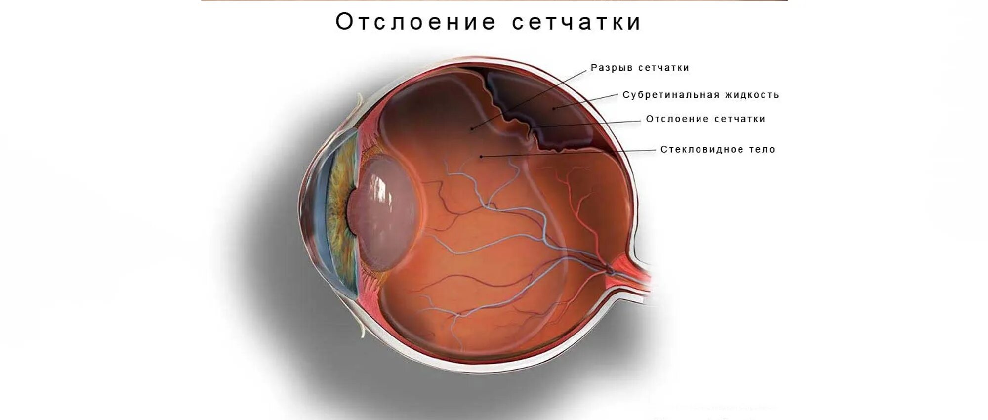 Неопластическая отслойка сетчатки. Субклиническая отслойка сетчатки. Глаукома отслойка сетчатки. Глазное дно отслоение сетчатки.
