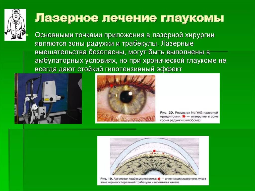 Глазная операция глаукомы. Лазерная хирургия глаукомы. Глаукома лазерная операция. Лазерное операция глуокомы. Лазерное лечение глаукомы.