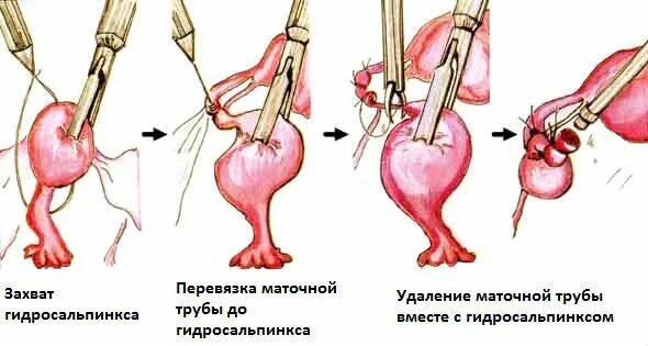Эндометриоз: как диагностировать и лечить - Klinik.by