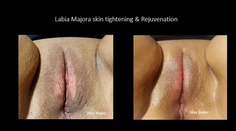 Anal bleaching pictures - 🧡 Anal bleaching pics 💖 Video Anal Bleaching ho...