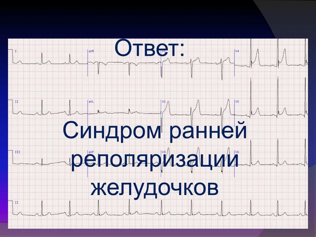 Нарушение процесса реполяризации желудочков в нижней стенке. Реполяризация миокарда желудочков ЭКГ. ЭКГ феномен ранней реполяризации. ЭКГ при синдроме ранней реполяризации. Синдром ранней реполяризации на ЭКГ.