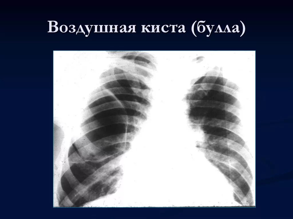 Буллезная болезнь легких рентген. Буллезная болезнь легких рентген. Булла доли легкого. Субплевральная булла кт. Булла доли легкого.