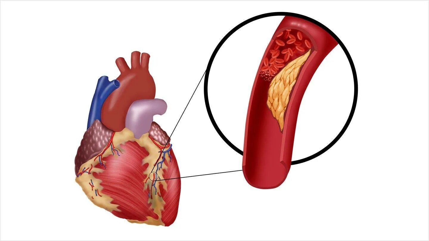 Атеросклероз сосудов ишемическая болезнь. ИБС атеросклероз коронарных артерий. Атеросклероз венечных артерий сердца. Атеросклеротическое поражение коронарных артерий. Тромб в желудочке