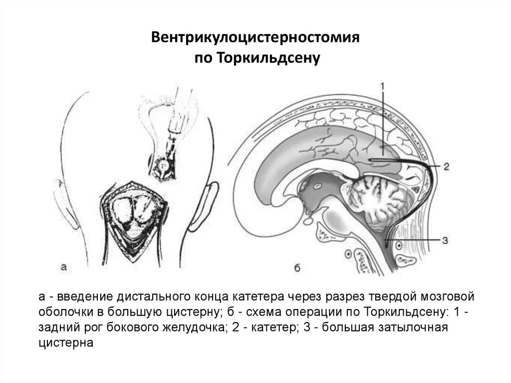 Операция гидроцефалия мозга. Эндоскопическая вентрикулостомия III желудочка. Вентрикулоцистерностомия при гидроцефалии. Вентрикулоцистерностомия по Торкильдсену ход операции. Вентрикулоцистерностомия дна третьего желудочка.