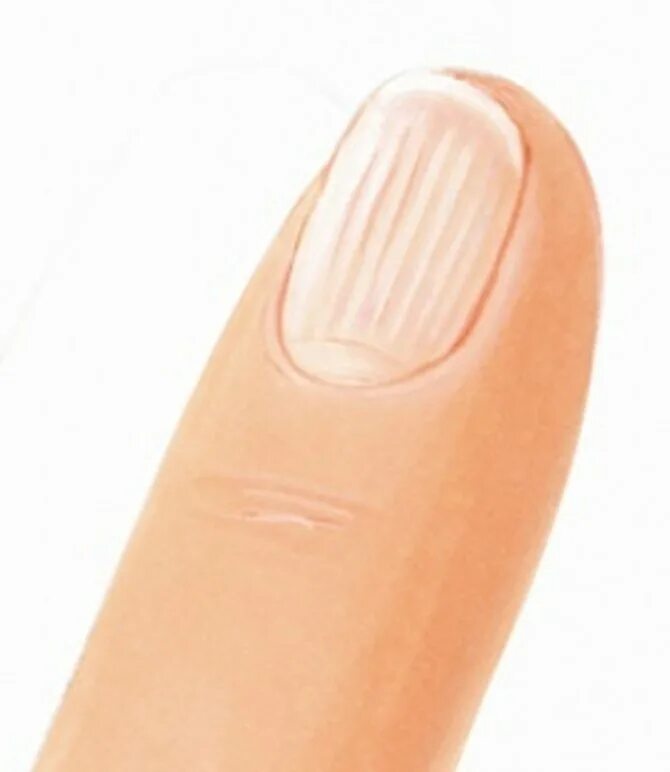 Почему ногти становятся ребристыми вертикально. Ребристстые ногти на руках. Ребристые полоски на ногтях.
