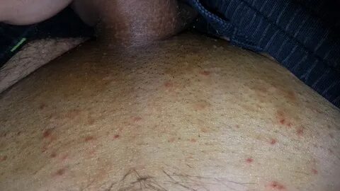 hot nude sex picture Skin Bumps On Genital Area, you can download Skin Bump...