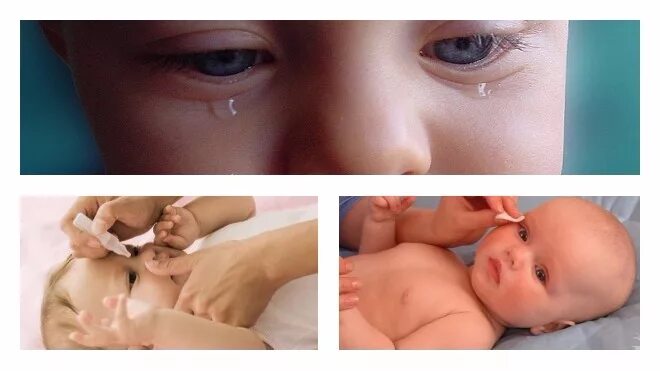 Массаж глаза у новорожденного. Дакриоцистит новорожденных Офтальма. Зондирование носослезного канала у новорожденных. Массаж слезного канала у новорожденных. Массаж слезного мешочка у новорожденного.