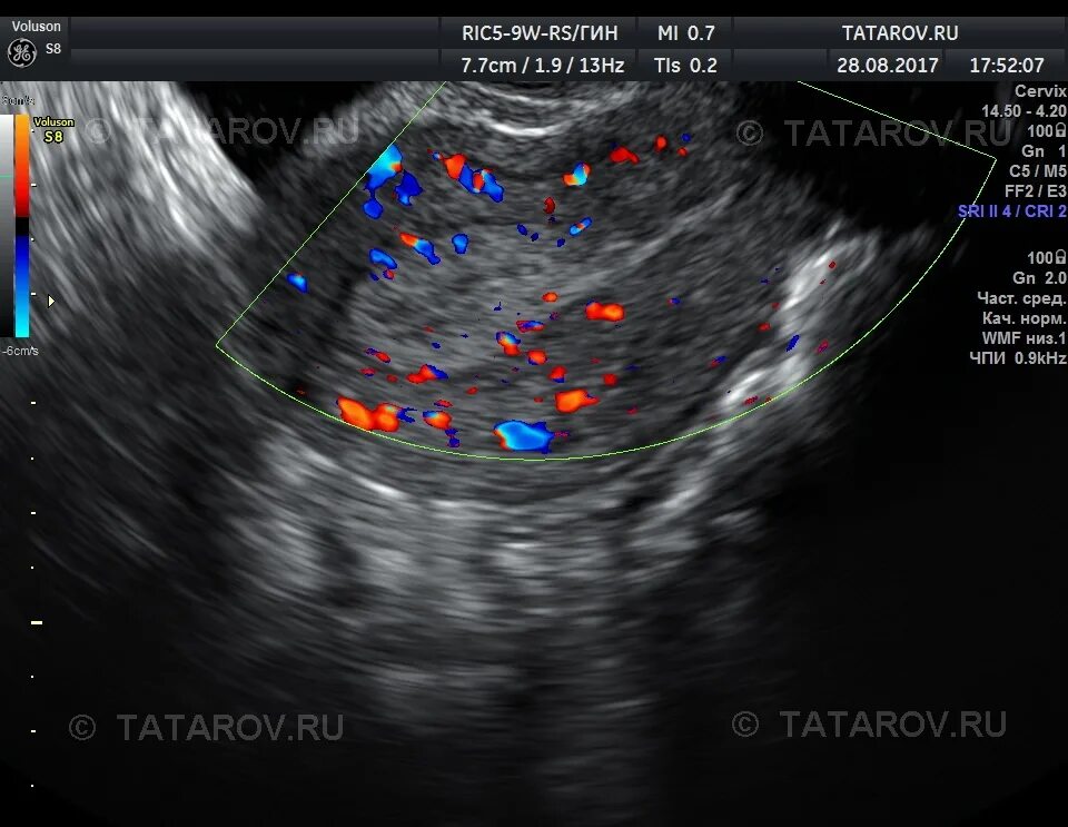 Эндометрия сосудов. Расширение аркуатных вен матки на УЗИ. Аркуатные артерии матки УЗИ. Расширенные вены в матке УЗИ. Расширение вен миометрия на УЗИ.