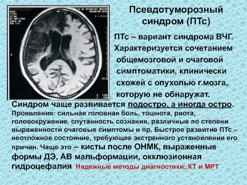 Псевдотуморозный синдром. Псевдотуморозная форма рассеянного склероза мрт. Псевдотуморозный Тип течения. Синдром внутричерепной гипертензии.