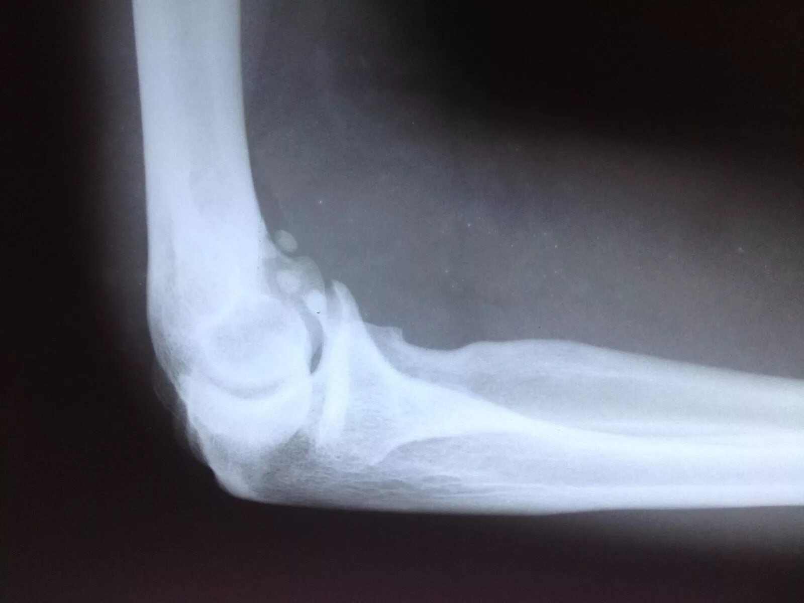 эпикондилит локтя рентген. эпикондилит локтевого сустава рентген. оссификат локтевого сустава рентген. калькулезный бурсит локтевого сустава рентген. эпикондилит локтевого сустава рентген.