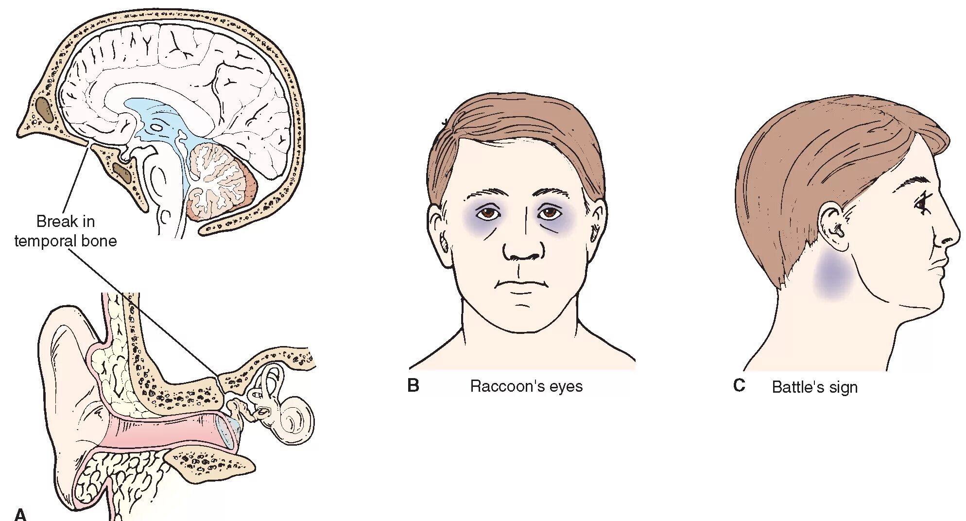 Сотрясение уха. Перелом основания черепа симптом очков. Симптом очков при переломе основания черепа. Перелом основания черепа ликворея. Перелом основания черепа симптомы.