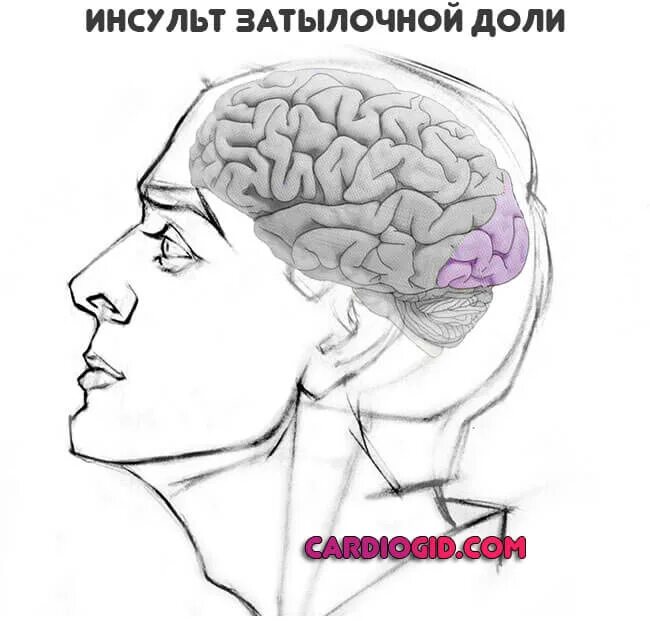 Симптомы микроинсульта мозга у женщин. Микроинсульт затылочной части. Инсульт микроинсульт головы. Микроинсульт симптомы у женщин.