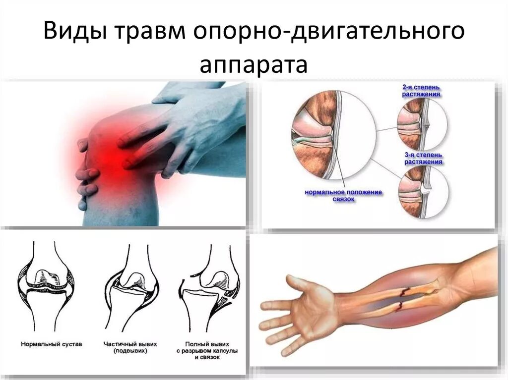 Какой вид травмы показан на рисунке. Основные виды травм опорно-двигательной системы. Признаки повреждения опорно-двигательного аппарата.. Основные виды травм опорно двигательного аппарата. Типы повреждений опорно двигательной системы.