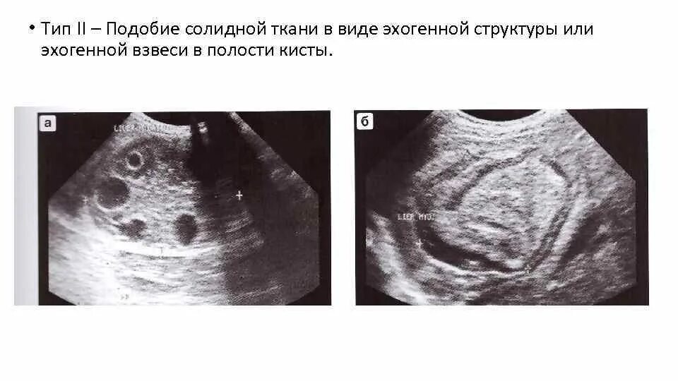 Паразитарная киста печени. Эхинококковая киста печени УЗИ. Паразитарные кисты печени на УЗИ. Эхинококковая киста на УЗИ. Эхинококковая киста печени протокол УЗИ.