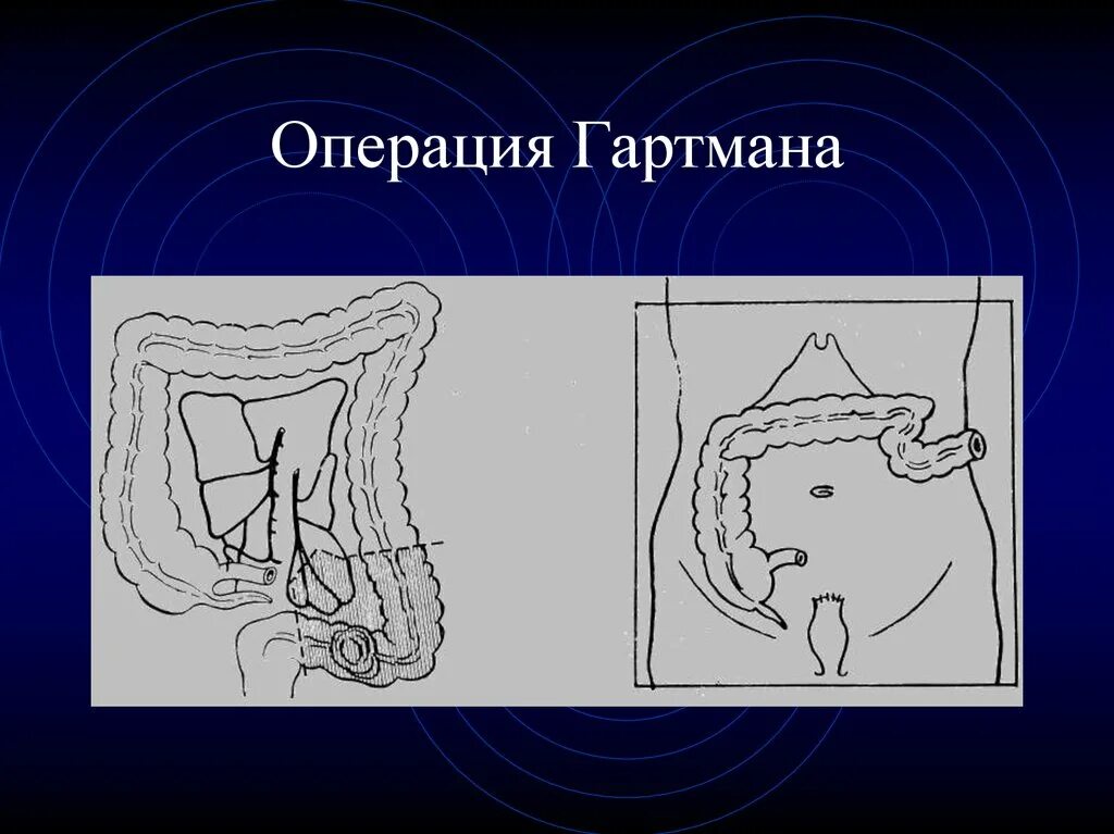 Операция типа Гартмана на толстой кишке. Операция Гартмана на прямой кишке. Операции через прямую кишку