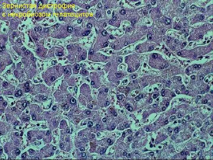 Зернистая дистрофия патанатомия. Зернистая паренхиматозная дистрофия. Гидропическая дистрофия печени. Зернистая дистрофия гепатоцитов. Белковые канальцы