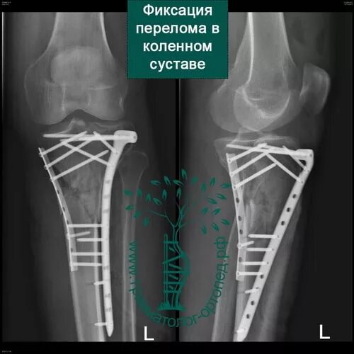 Внутрисуставной перелом мыщелка. Внутрисуставной перелом большеберцовой кости коленного сустава. Внутрисуставной импрессионный перелом большеберцовой кости. Импрессионный перелом мыщелка правой большеберцовой кости».. Перелом плато большеберцовой кости.