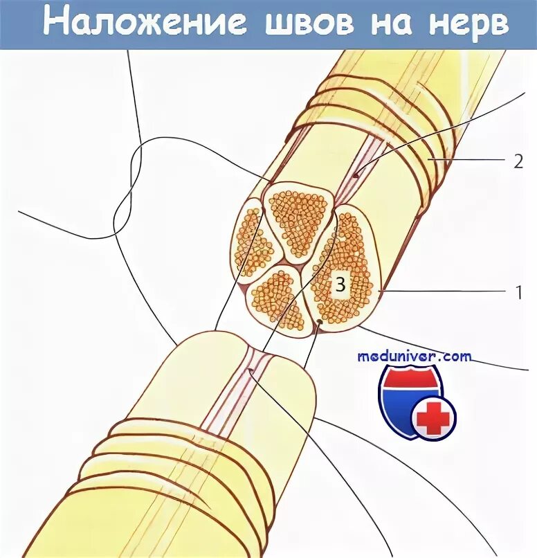 Операции на сосудах нервах сухожилиях