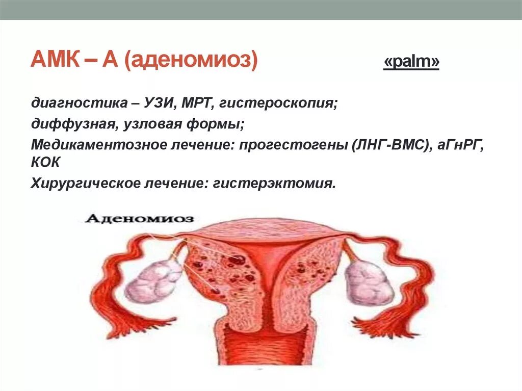 Эндометриоз тела матки (аденомиоз). Формы аденомиоза матки.