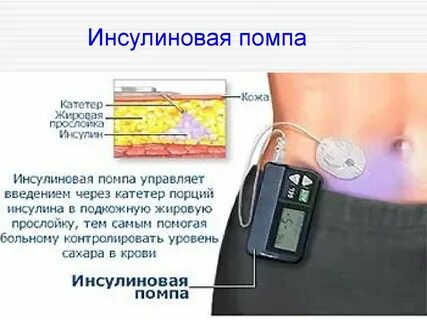 Помпа при диабете
