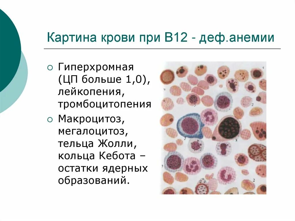 Картина костного мозга при в12 дефицитной анемии. Костный мозг при в12 дефицитной анемии. Картина крови при в12 дефицитной анемии. Картина крови при эритроцитозе.