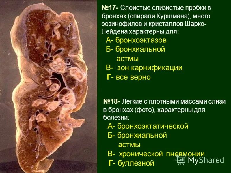 Пробки в бронхах. Пробки в бронхах. Тип мокроты при бронхиальной астме. Пробки в бронхах. Пробки в бронхах.