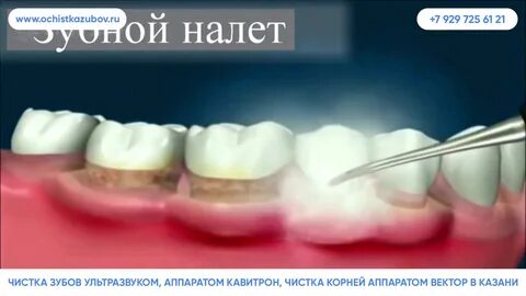 Температура после удаления камня