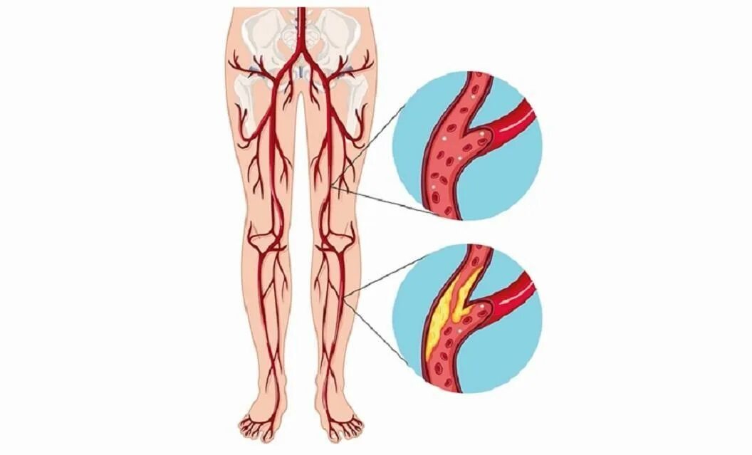 Тромбоз артерии лечение. Облитерирующий атеросклероз нижних конечностей. Циркуляция крови в конечностях. Нарушение кровообращения нижних конечностей.