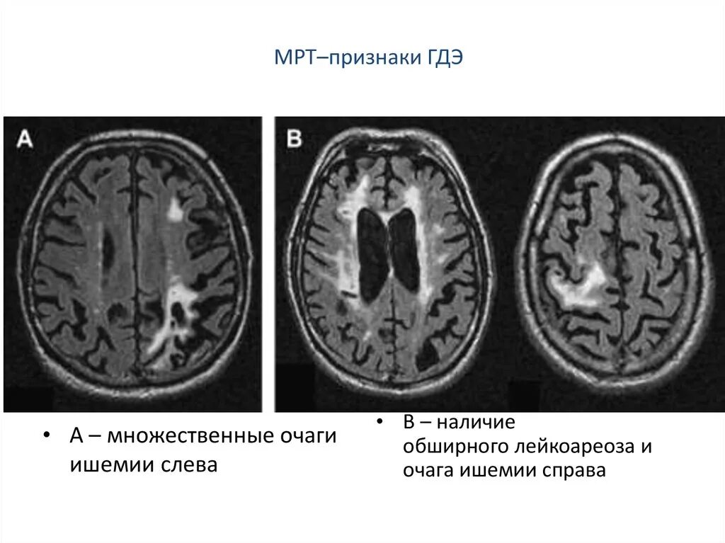 Очаги ишемии головного мозга. Деменция на мрт головного мозга. Сосудистая деменция мрт. Лейкоареоз мрт. Кт головы при деменции.