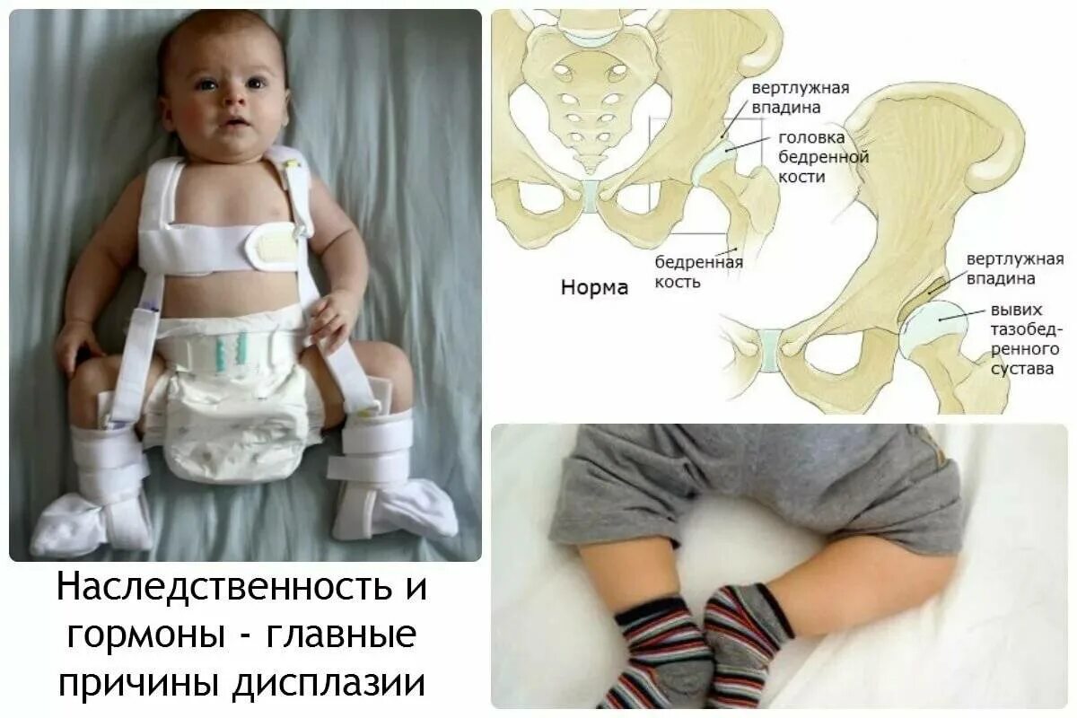 Дисплазия сустава у новорожденного лечение. Нелеченная дисплазия тазобедренных суставов у детей. Дисплазия тазобедренных суставов 3ст.