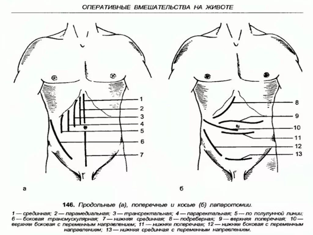 Брюшная стенка после операции. 1. Верхне-срединная лапаротомия. Лапаротомия топографическая анатомия. Нижнесрединная лапаротомия. Верхнесрединная лапаротомия показания.