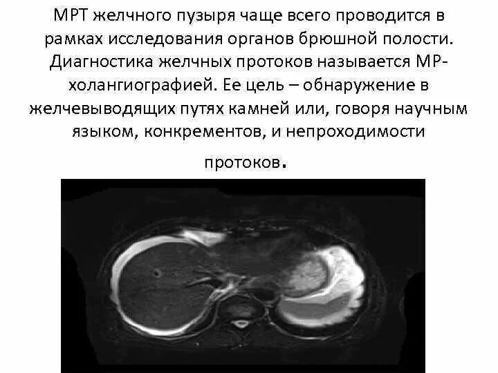 Камни в желчном мрт. Магнитно-резонансная томография желчного пузыря. отключенный желчный пузырь мрт.