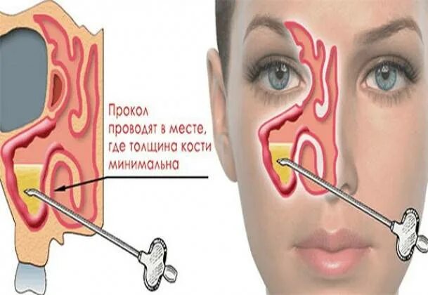 Как делают проколы при гайморите взрослым