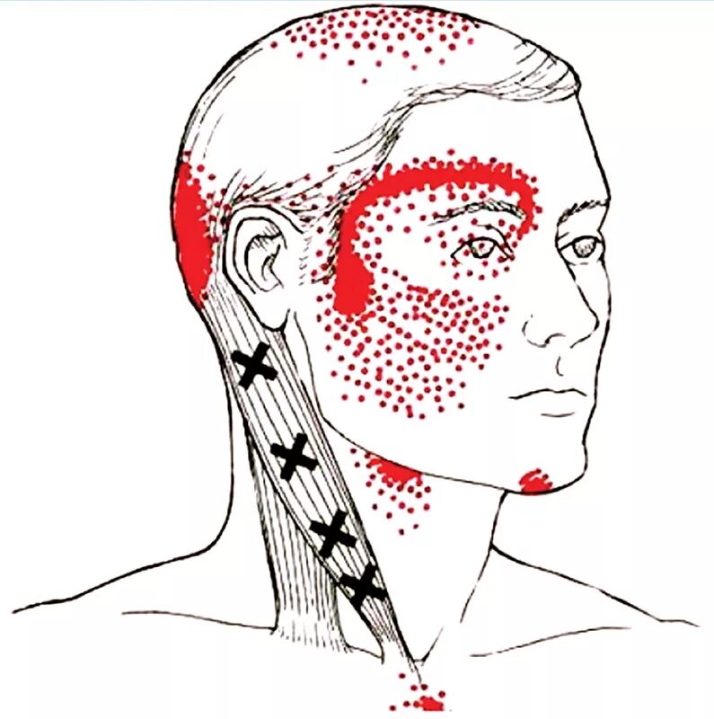 Триггерные точки мышц шеи. Миофасциальные триггерные точки головы. Триггерные точки мышц шеи и головы. Подзатылочные мышцы триггерные точки.