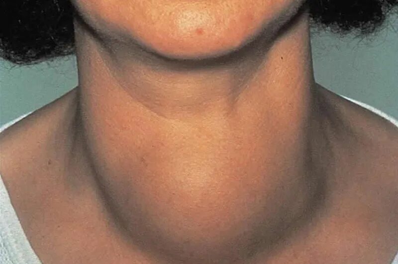 заболевания паращитовидной железы. гиперплазия щитовидной железы у мужчин. щитовидный хрящ. патология паращитовидных желез. шея женщины.