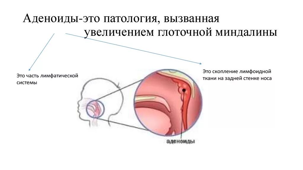 Аденоиды признаки