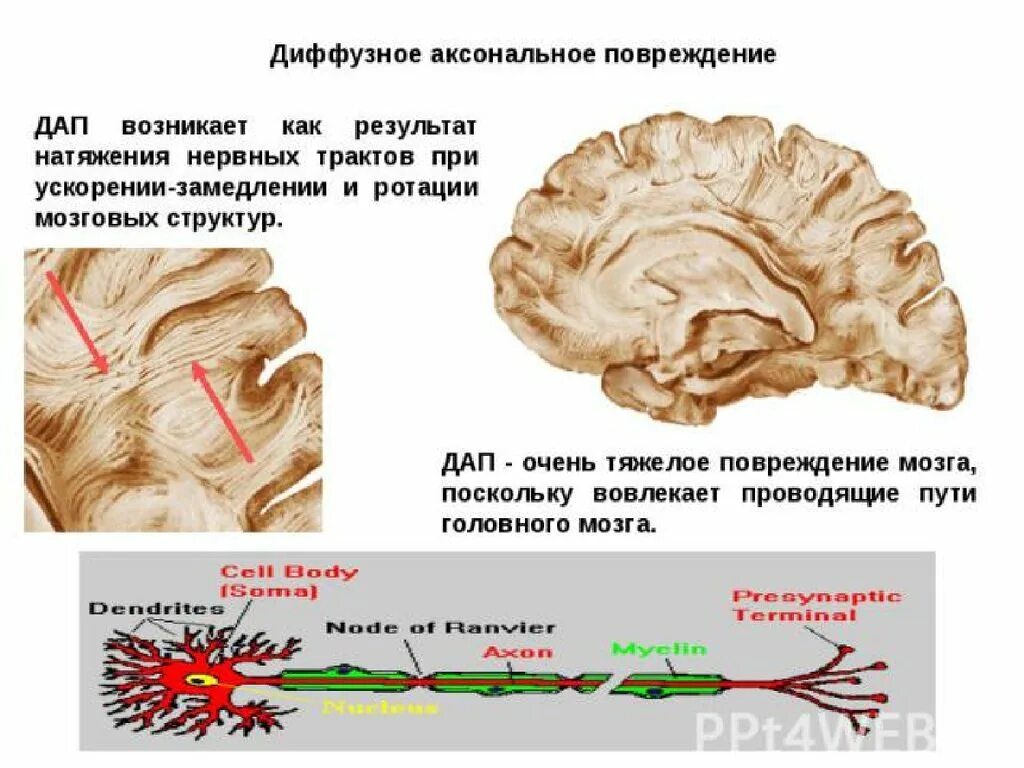 Диффузные нарушения мозга. Разрыв аксонов головного мозга. Диффузное аксональное поражение головного мозга. Дифузноаксенальное повреждение. Диффузное аксональное повреждение головного.