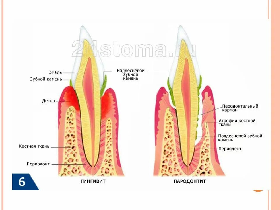 Зубной на латыни. Пародонтит зубной камень. Заболевание десен пародонтит. Поддесневой камень гингивит. Гингивит пародонтит пародонтоз классификация.