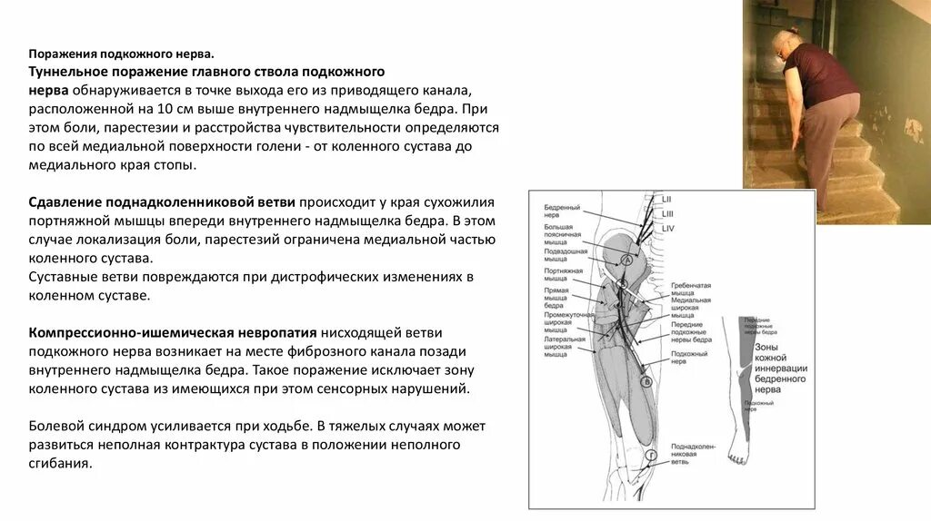 Бедренный нерв симптомы лечение. Нейропатия подкожного бедренного нерва. туннельный синдром большеберцового нерва. синдромы поражения (невропатия бедренного нерва. компрессионно-ишемическая невропатия бедренного нерва.