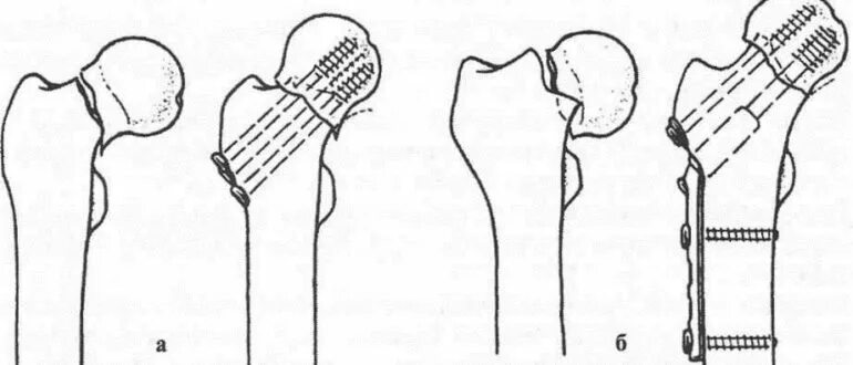 Остеосинтез перелома шейки бедра канюлированными винтами. Шейка бедра перелом остеосинтез. Рисунок остеосинтеза перелома шейки бедра канюлированными винтами. Остеосинтез при переломе шейки бедренной кости.