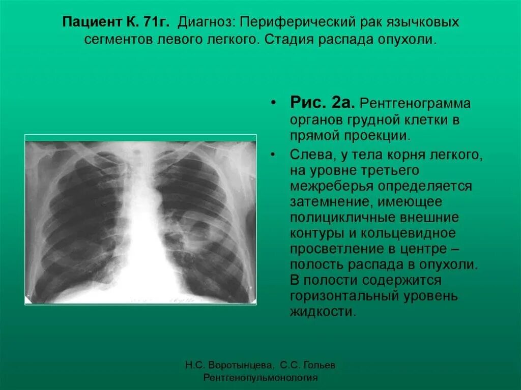 Тень в верхней доле. Линейный фиброз рентген. Плевральные наслоения. Объёмное образование левого лёгкого. Фиброз нижней доли левого легкого.