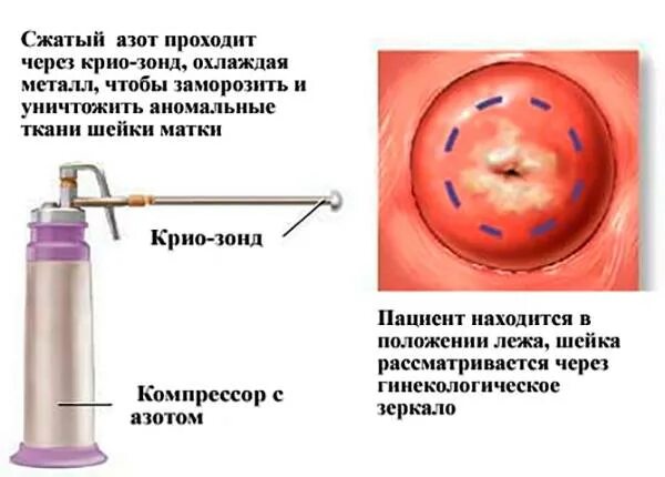 Половая жизнь после биопсии