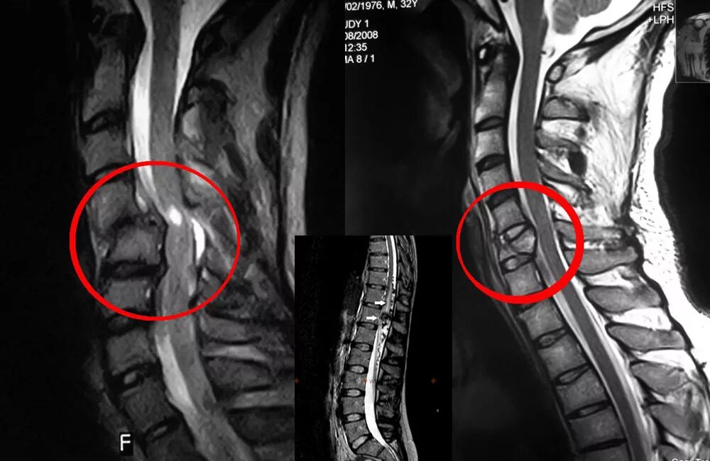 Спинальная нестабильность что это. Компрессионная миелопатия шейного отдела позвоночника мрт. Миелопатия шейного отдела позвоночника мрт. Мрт шейного отдела позвоночника остеохондроз. Компрессионная миелопатия грудного отдела позвоночника.