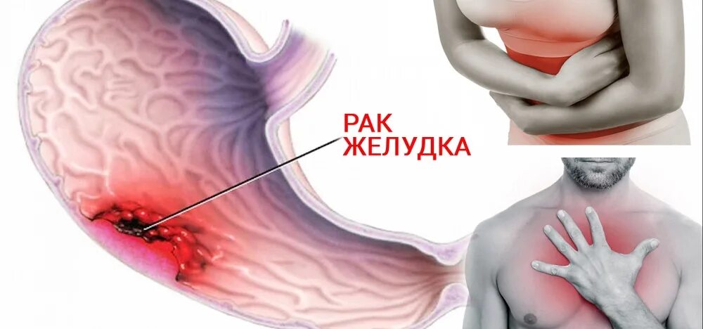 Онкология желудка симптомы. Злокачественное новообразование желудка. Опухолевые заболевания желудка. При язве можно печень